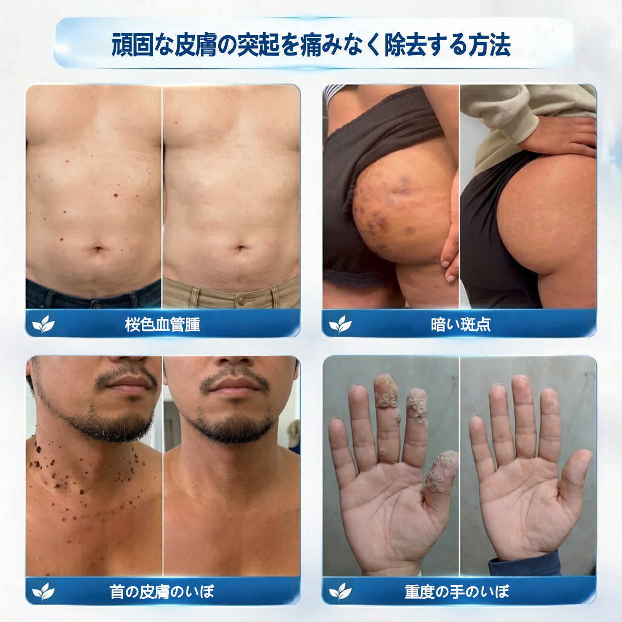 🖋️🖋️🖋️公式ストア🔥7 日間ピンポイントケアローラー 痛みなし・傷跡残らないタイプ