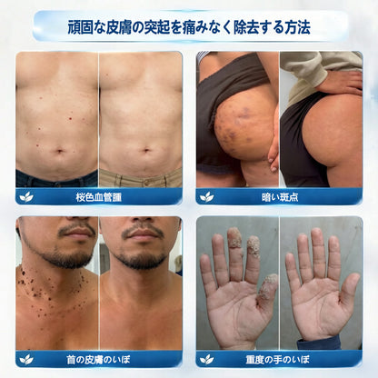 🖋️🖋️🖋️公式ストア🔥7 日間ピンポイントケアローラー 痛みなし・傷跡残らないタイプ